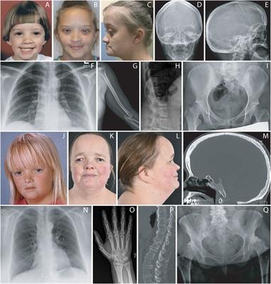 Case report: Extending the spectrum of clinical and molecular findings in FOXC1 haploinsufficiency syndrome